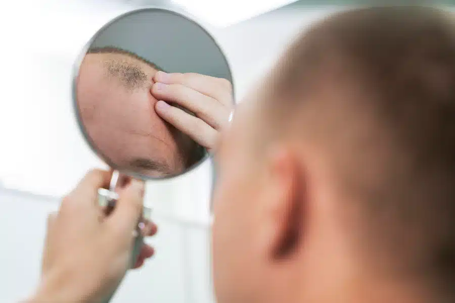 sonhar que está ficando careca