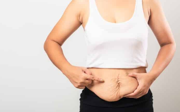 What is diastasis