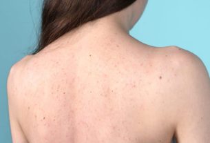 Bacne: descubra o que causa e como tratar a acne nas costas