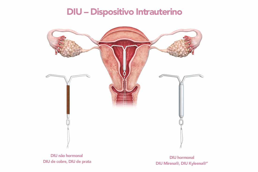 Kyleena IUD: How it works, advantages and disadvantages of the method