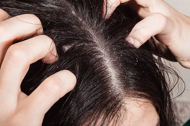 Oily hair – Causes, care + ways to get rid of oiliness