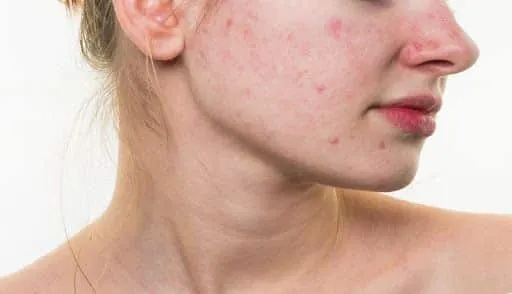 Acneic Skin - What is it?