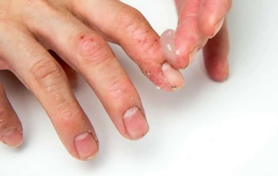 Hand allergy – Possible causes, symptoms and treatments