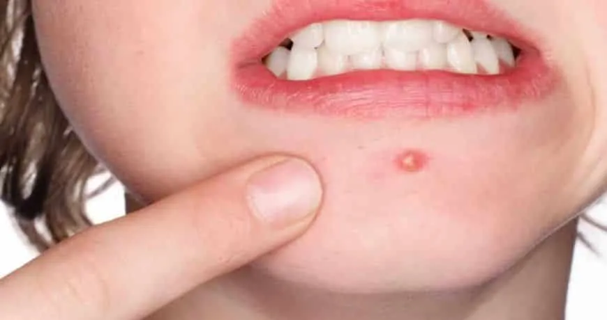 Inflamed pimple - Tips on how to treat and prevent its appearance