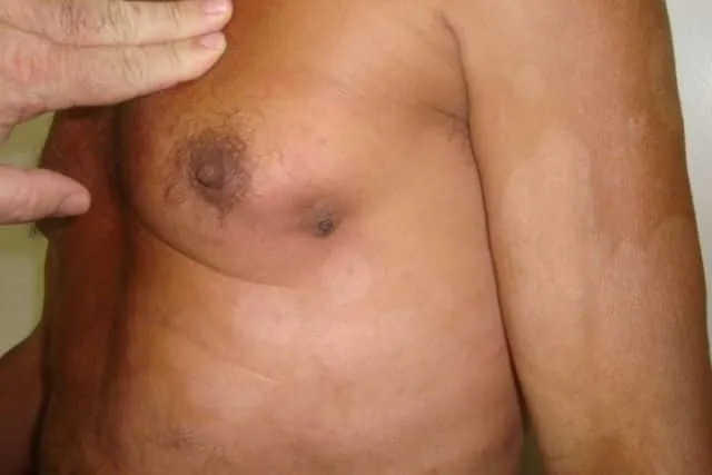 Breast cancer in men: symptoms