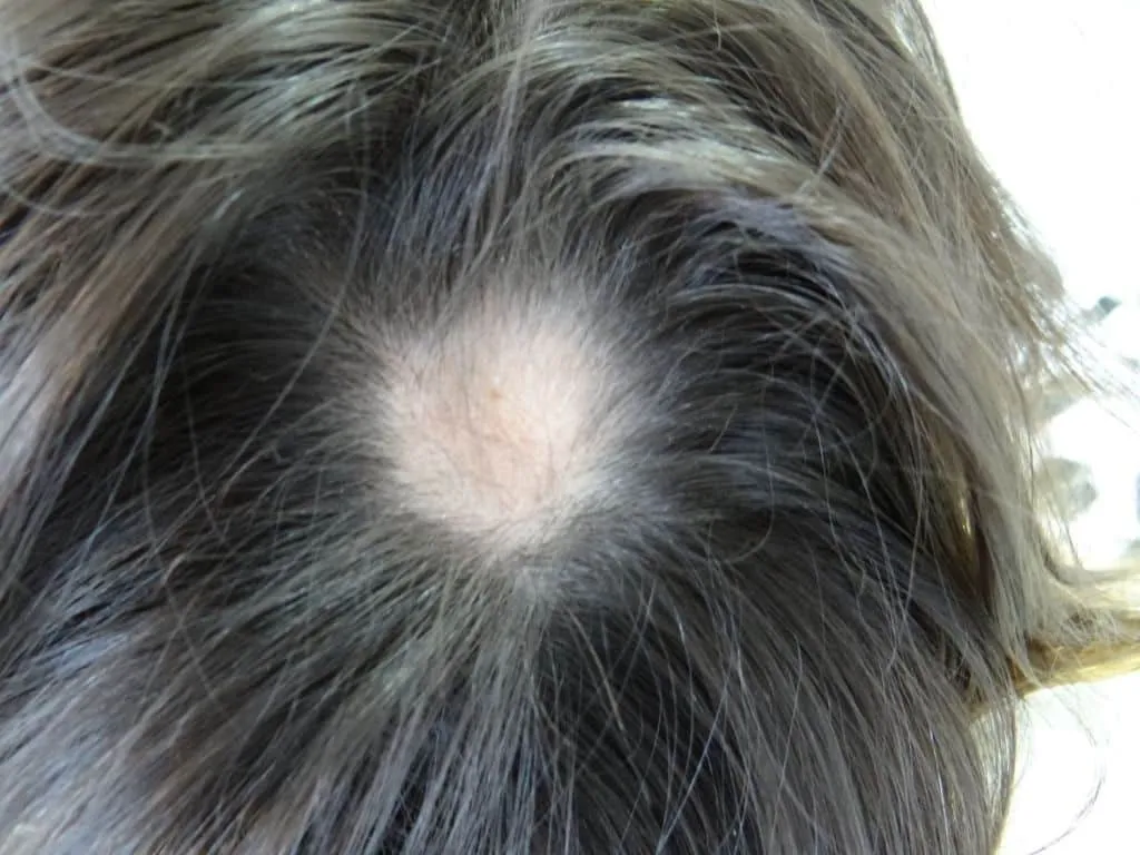 ringworm on the scalp