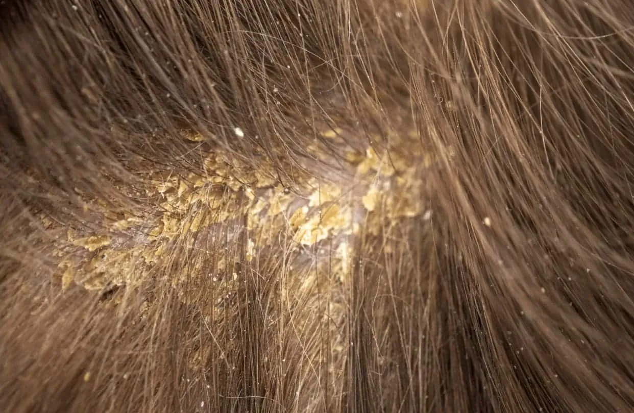 scalp with seborrheic dermatitis