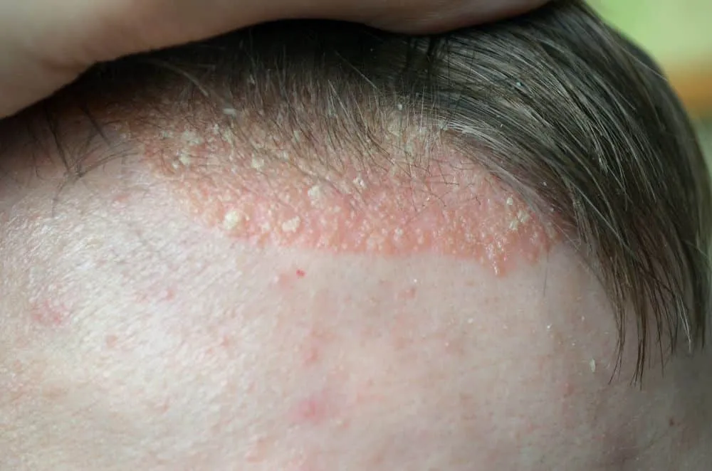 psoriasis on the head