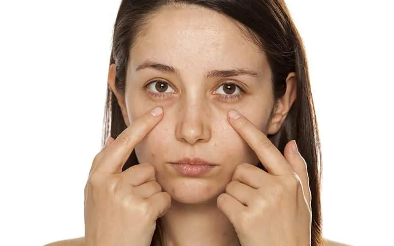 Types of dark circles – See which one is yours and how to take care of it