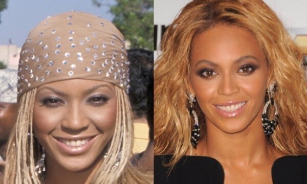 Nose surgery: celebrities who have had it done