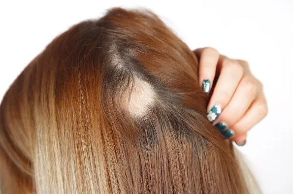 Alopecia areata: understand the condition of the former BBB Slovenia
