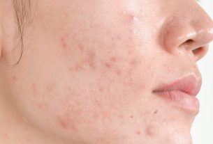 Acne fúngica: o que é, causas, sintomas e como tratar