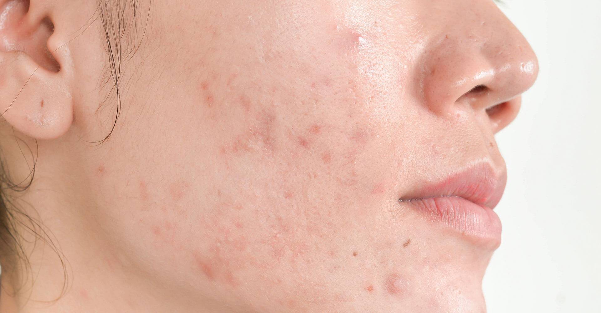 Acne fúngica: o que é, causas, sintomas e como tratar