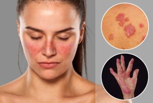 15 main symptoms of lupus (with online test)