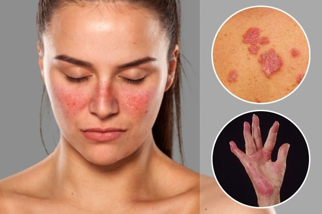 15 main symptoms of lupus (with online test)