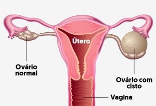 15 symptoms of ovarian cyst (with online test)