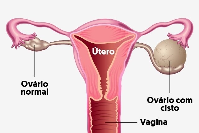 15 symptoms of ovarian cyst (with online test)