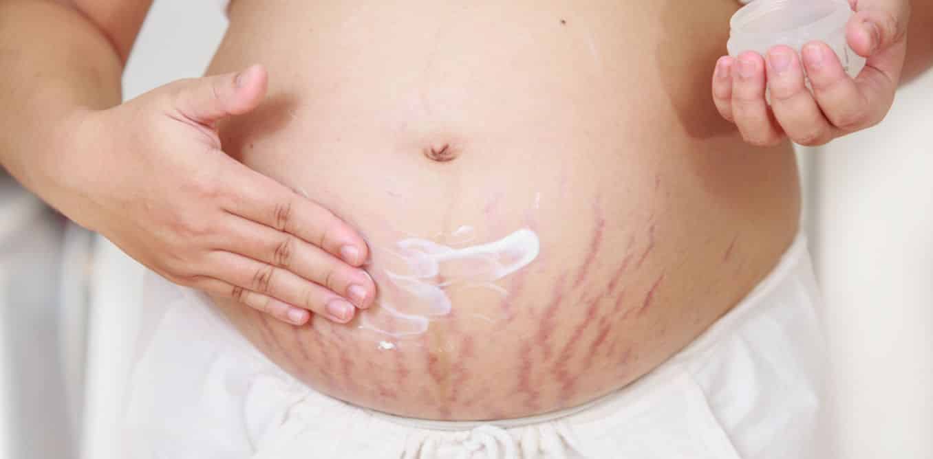 Red stretch marks: causes, prevention and treatment