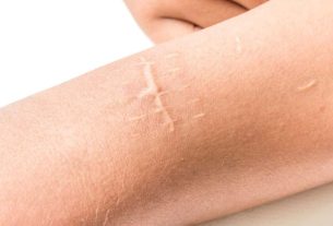 How to remove scars - Treatment tips to get rid of marks