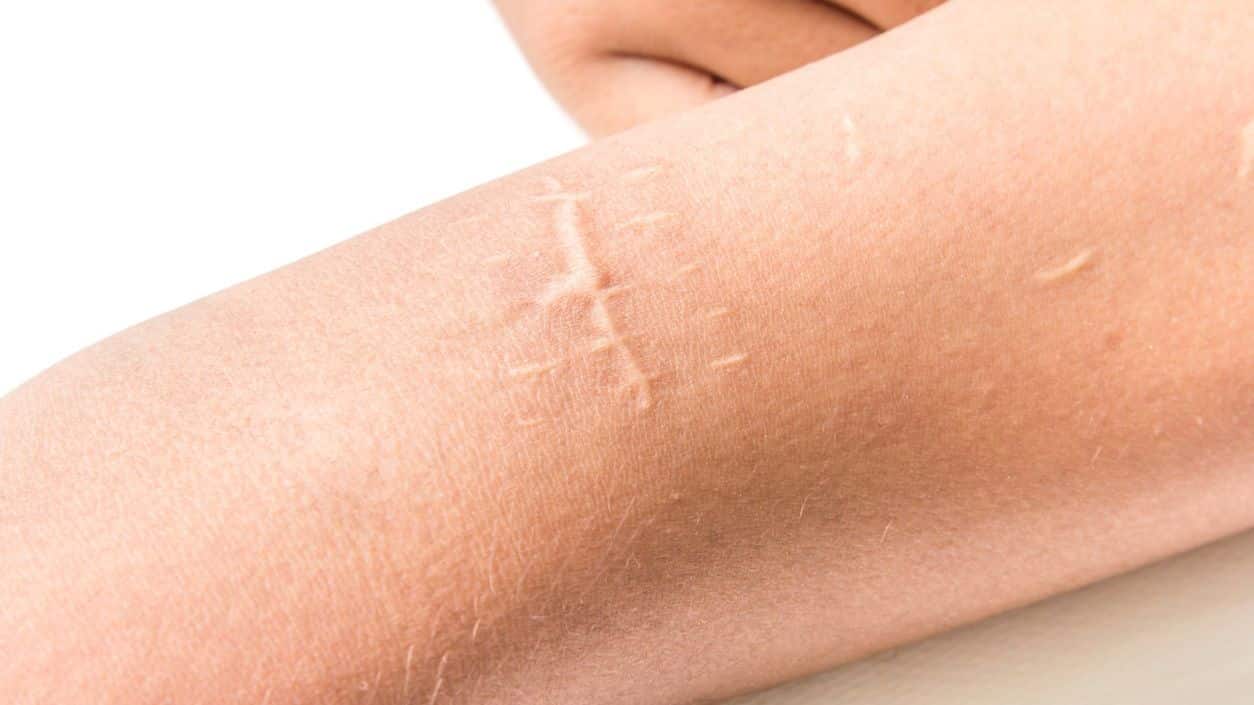 How to remove scars - Treatment tips to get rid of marks