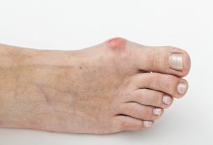 Bunion: what it is, symptoms, causes and treatment