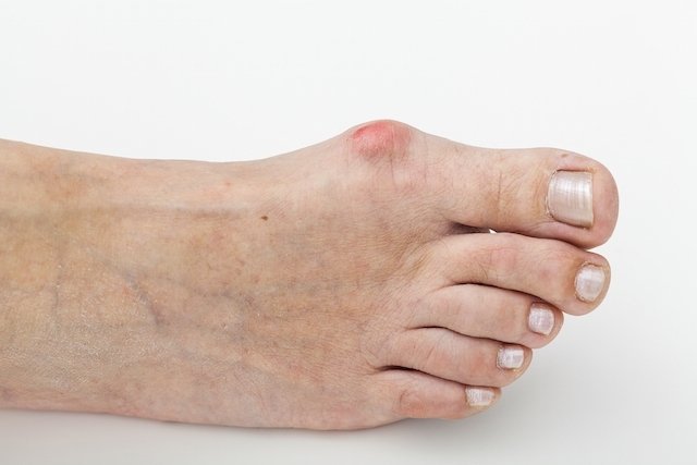 Bunion: what it is, symptoms, causes and treatment