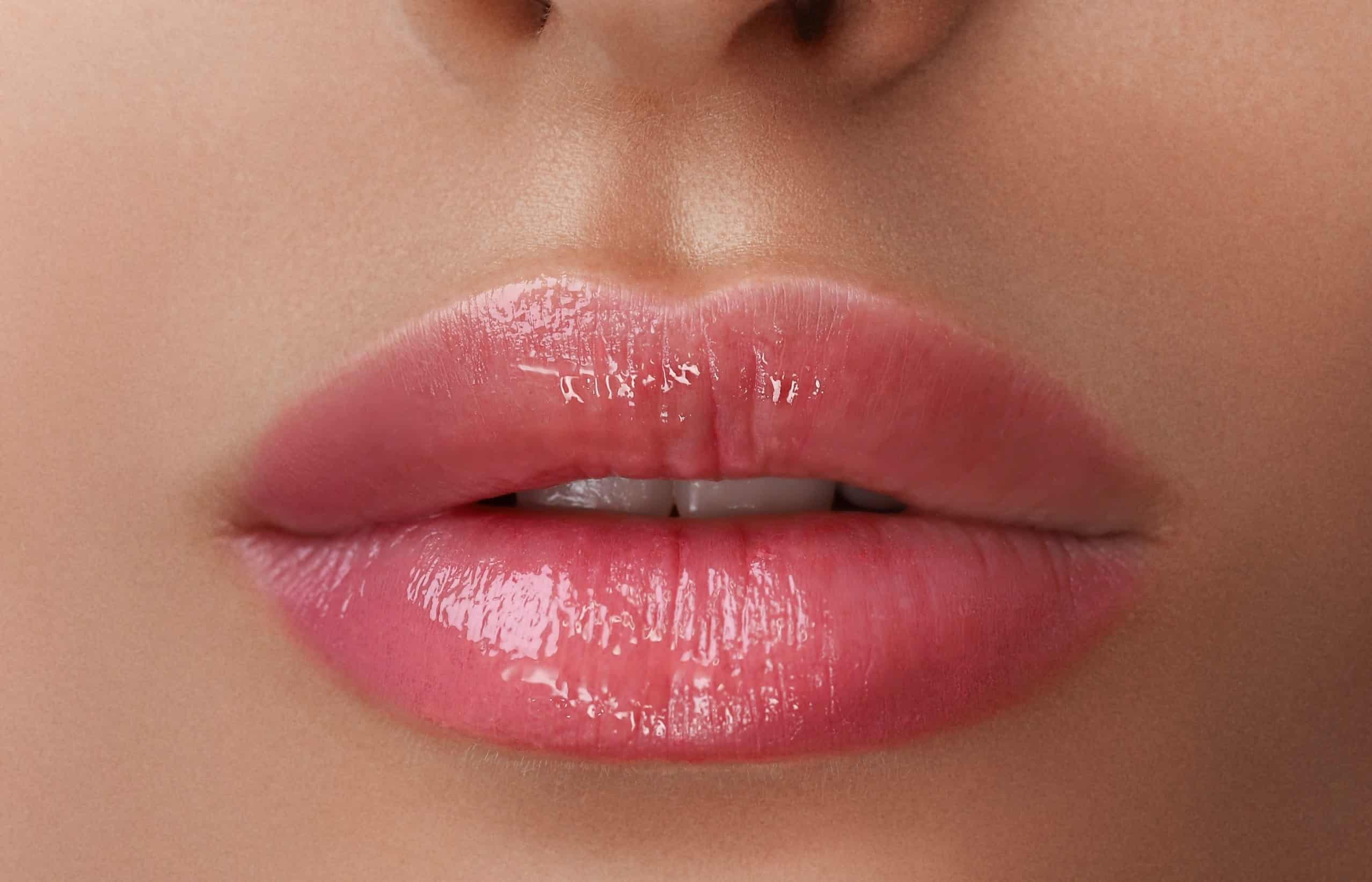 Preenchimento labial - O que é, como é feito, contraindicações, valores