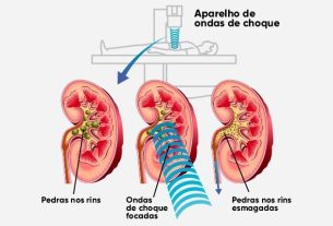 Kidney stone surgery: when to do it, types and recovery