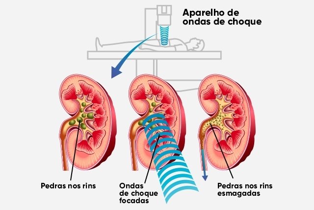 Kidney stone surgery: when to do it, types and recovery