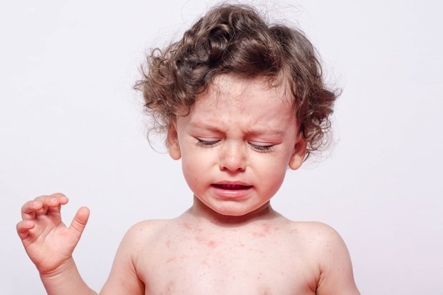 8 main measles symptoms (with photos)