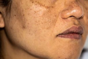 Remédio para melasma - saiba as melhores formas de tratamento