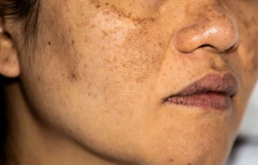 Remédio para melasma - saiba as melhores formas de tratamento