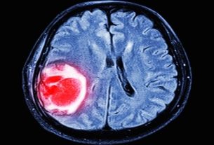 Cerebral thrombosis: what it is, symptoms, causes and treatment