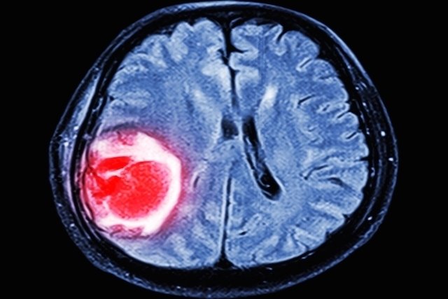 Cerebral thrombosis: what it is, symptoms, causes and treatment