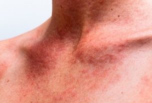 Treatment for hives: Top 6 options