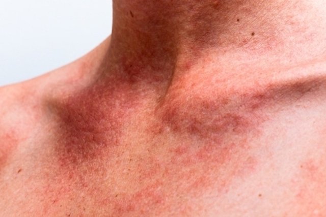 Treatment for hives: Top 6 options