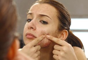 Anticoncepcional para acne? Saiba se o remédio realmente combate isso