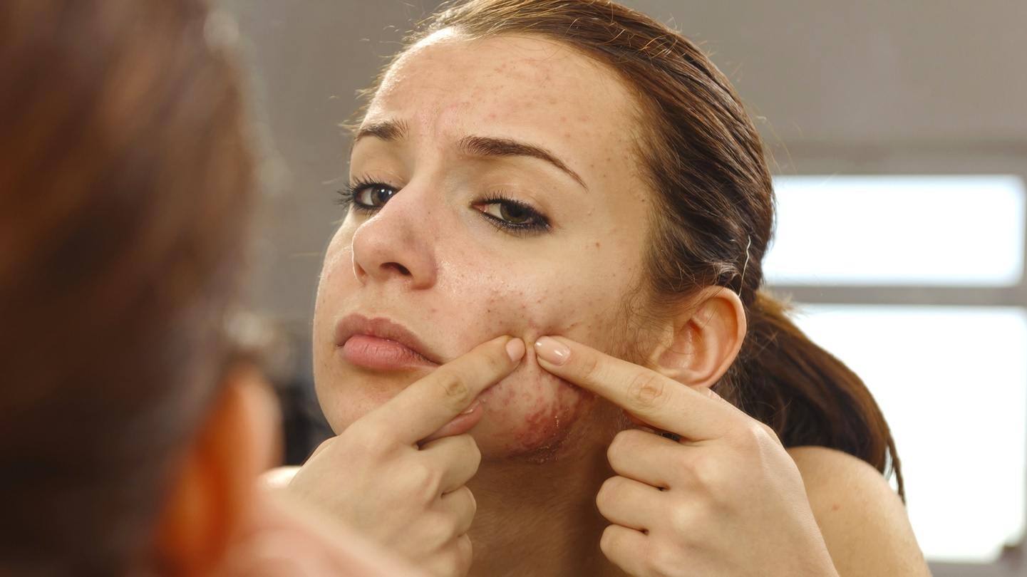 Anticoncepcional para acne? Saiba se o remédio realmente combate isso