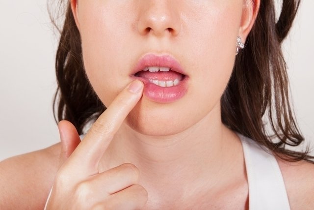 Herpetic stomatitis: what it is, causes and treatment