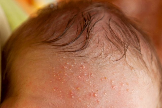 Lump on baby's face: 4 causes and what to do (with photos)