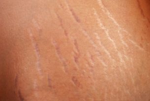 7 options to remove red stretch marks