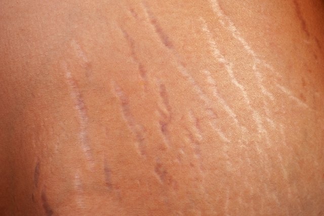 7 options to remove red stretch marks