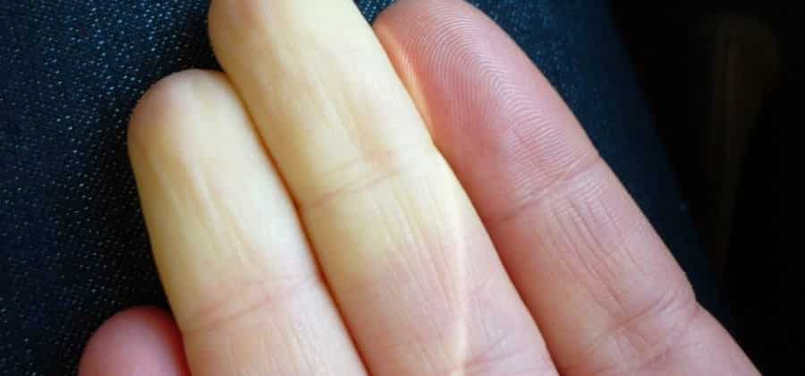 Doença de Raynaud atinge principalmente mulheres e frio demais pode ser sintoma