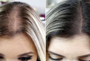 Queda de cabelo - quais são as causas, como evitar e como tratar