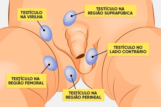 Cryptorchidism: what it is, causes and treatment