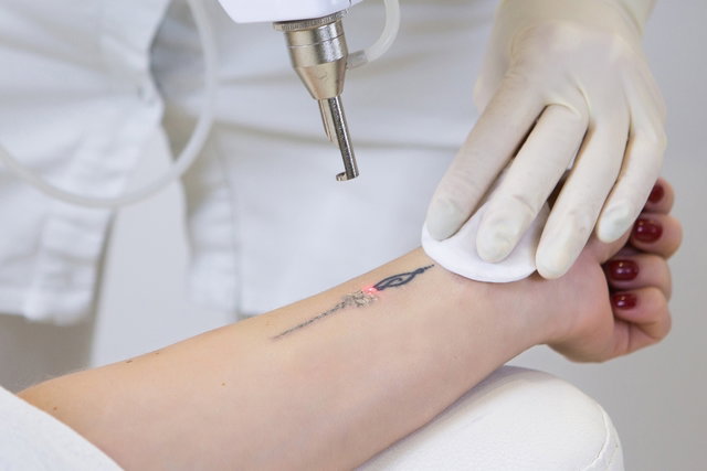 Tattoo removal: how to remove and care