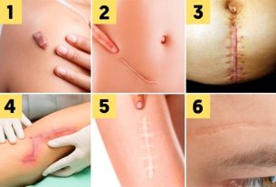 Surgery to remove scar: how it is done, recovery and who can do it