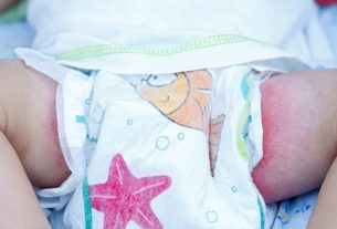 How to take care of baby diaper rash