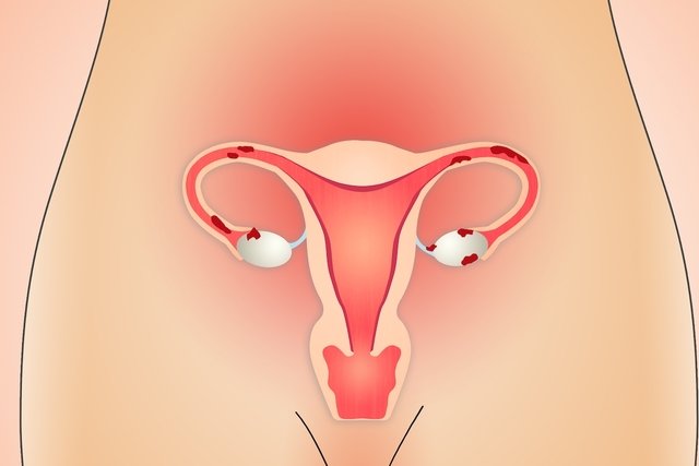 Quem tem endometriose pode engravidar?