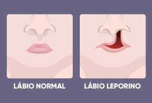 Cleft lip: what it is, causes and treatment